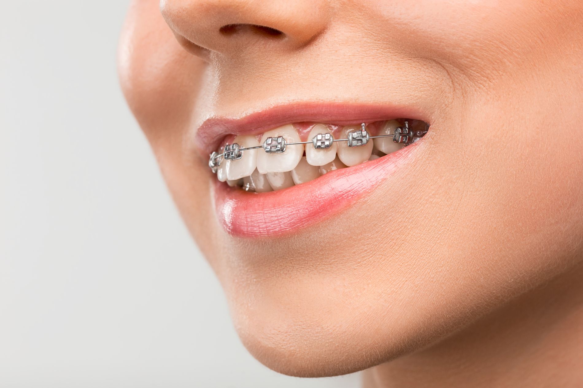 Teeth braces