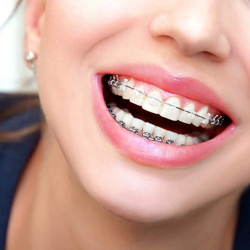 Smile makeover
