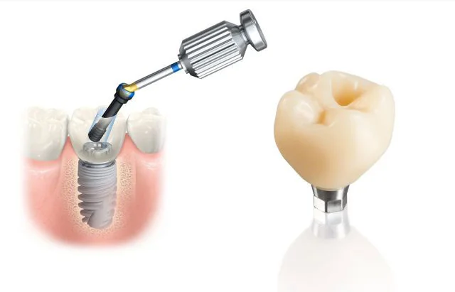 dental_implants_how Smile makeover