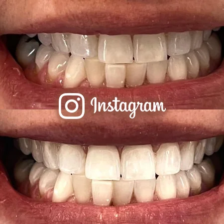 Allure - Invisalign