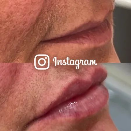 Allure - Lip Fillers