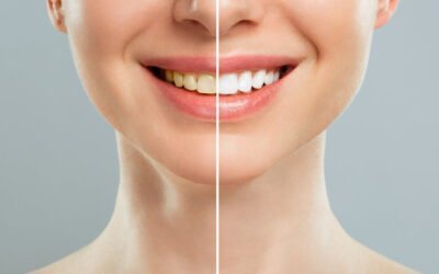 Airflow Teeth Cleaning in Barnet: What It Removes, What It Costs and What It Can’t Do