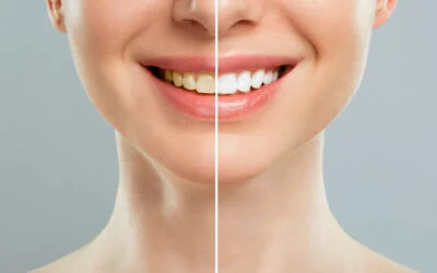 Airflow Teeth Cleaning in Barnet: What It Removes, What It Costs and What It Can’t Do