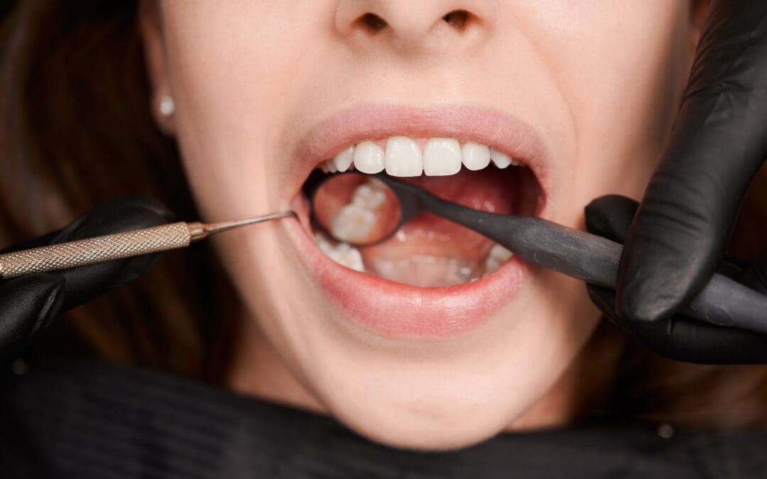 Amalgam vs White Fillings: Which Is Better for Your Teeth?