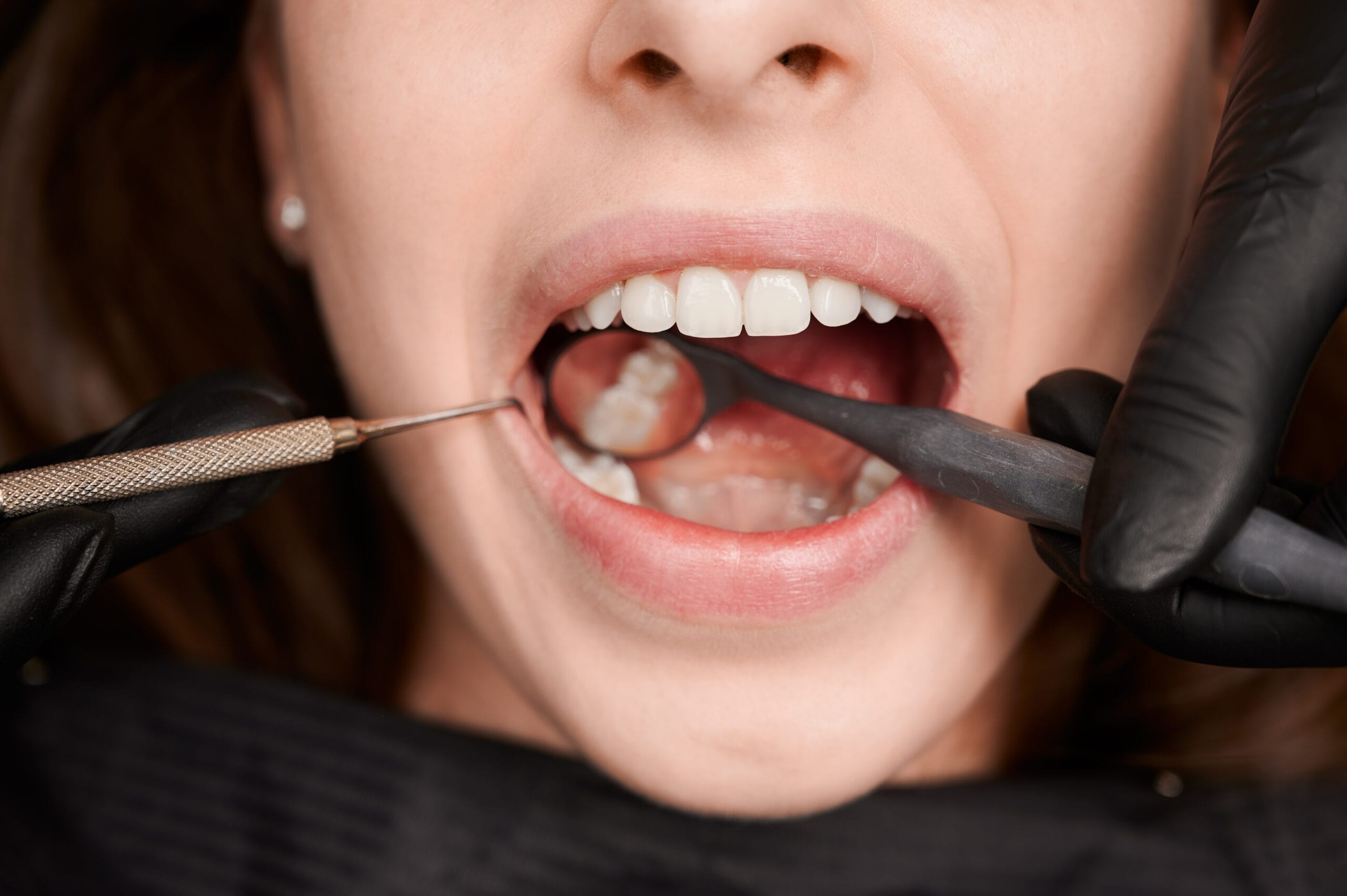 Amalgam or white fillings: dental health and smile