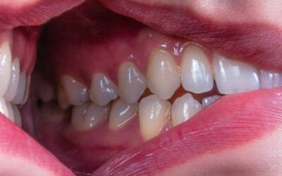 Dental Implants in North London: What Nobody Tells You Before You Book