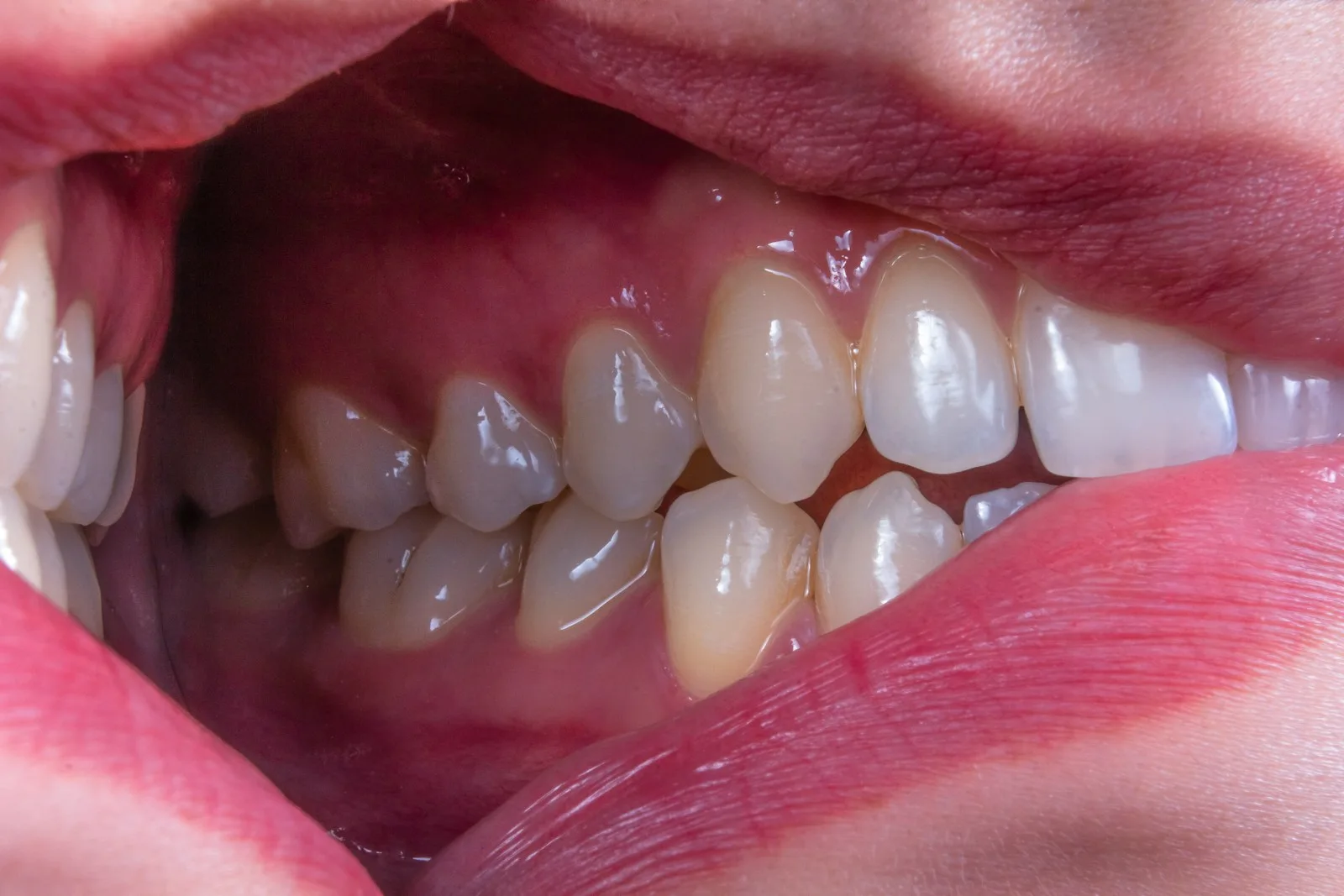 a person's mouth with dental implants