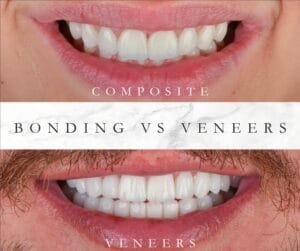 Natural-looking Emax porcelain veneers at Allure Dental, Barnet